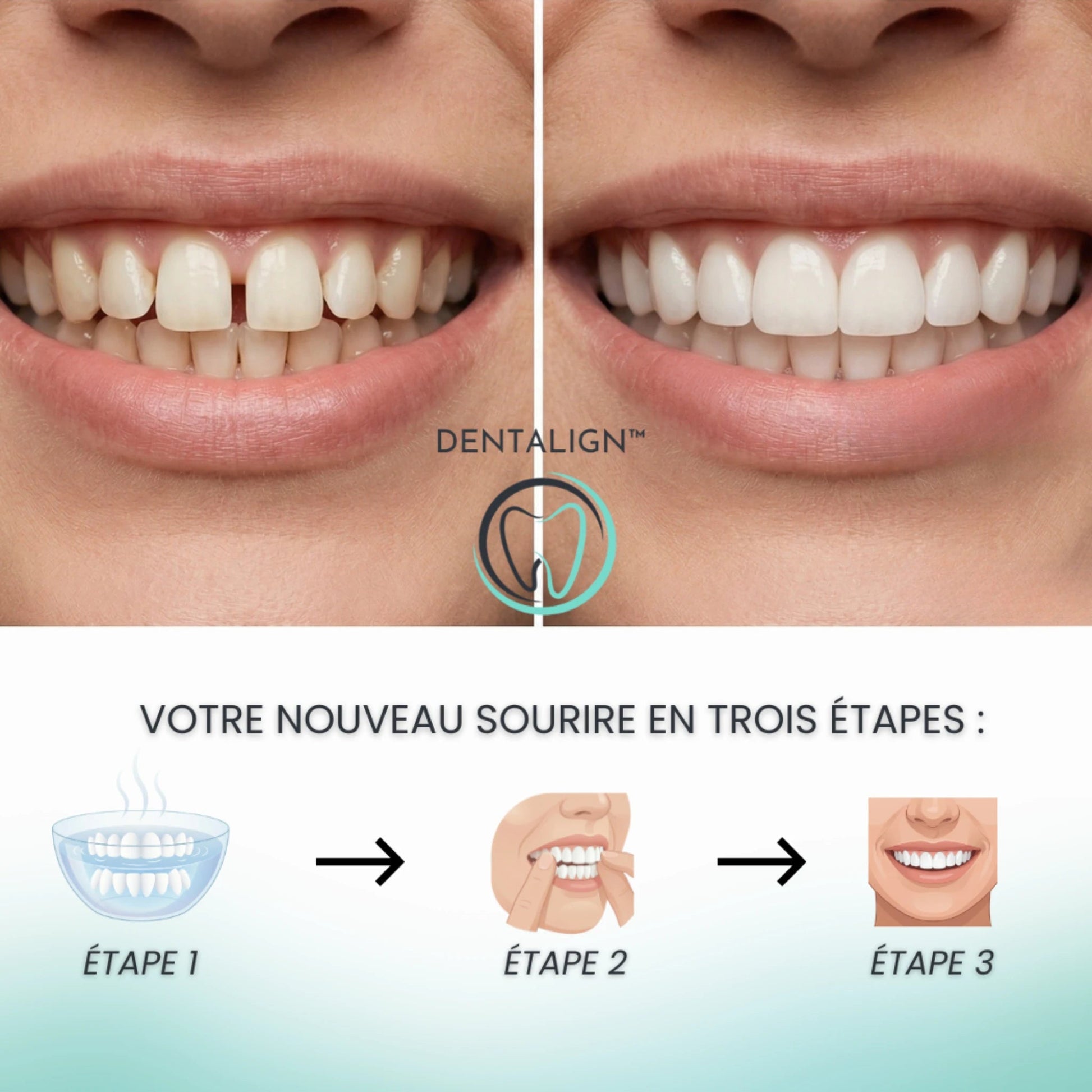 Facettes Amovibles - Dentalign™ - DENTALIGN FR3